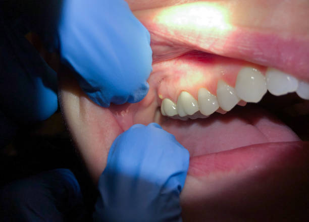 Best Emergency Care for Gum Disease in Montgomery, AL